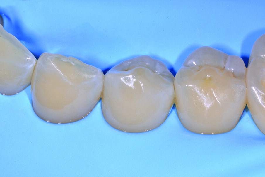 Figg. 6-9_Le superfici occlusali erose e/o abrase vengono ricostruite con strati sottili di smalto composito Enamel Plus HRi Bio Function. 