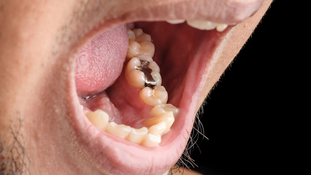 Weltgemeinschaft beschließt Aus für quecksilberhaltiges Amalgam bis 2034