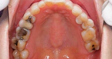 ¿Estamos preparados para la erradicación de la amalgama?