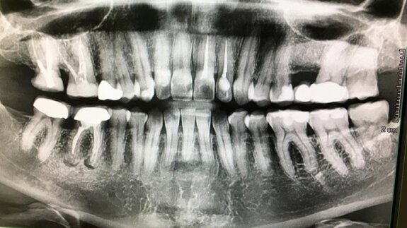 Diagnostic tips for bone lesions with DTX Studio Clinic
