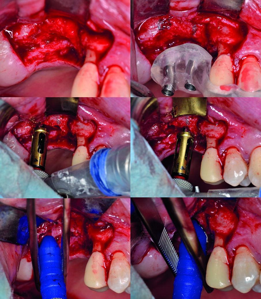 Fig. 2 - Creazione dei tunnel implantari e sollevamento della membrana sinusale. La posizione dei tunnel implantari è marcata sulla cresta vestibolare con l’aiuto di una dima radiografica; successivamente alla preparazione dei tunnel, si procede al sollevamento della membrana sinusale attraverso il sistema idropneumatico.