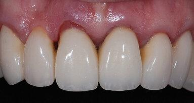 Restoring in the other color: pink