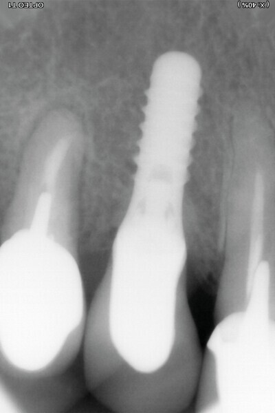 Fig. 11 : Contrôle radiologique à 10 ans. 