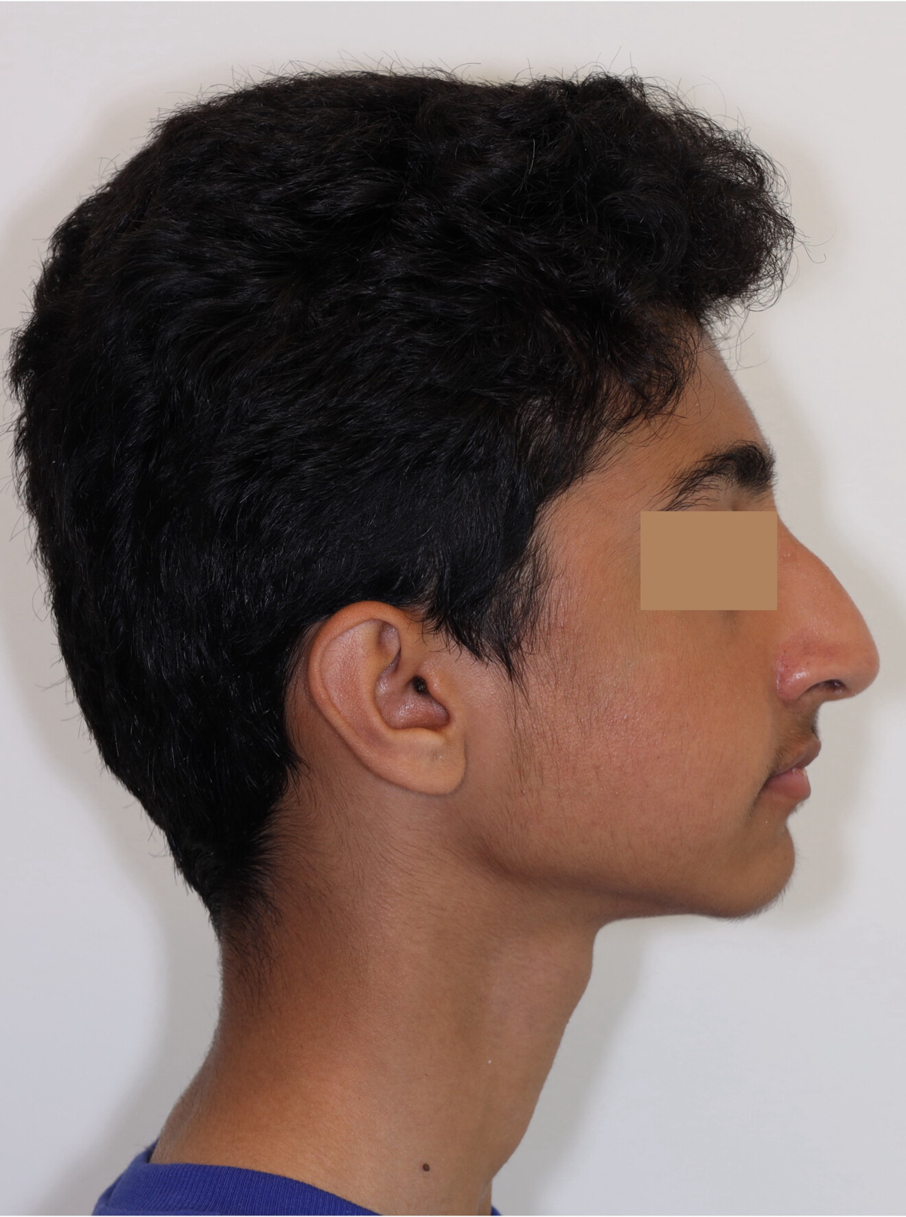 Figs. 7a–c: Extra-oral photographs after the second phase of treatment.