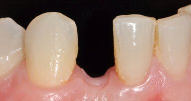 Jednoduchá rekonstrukce u problematického případu s omezeným prostorem