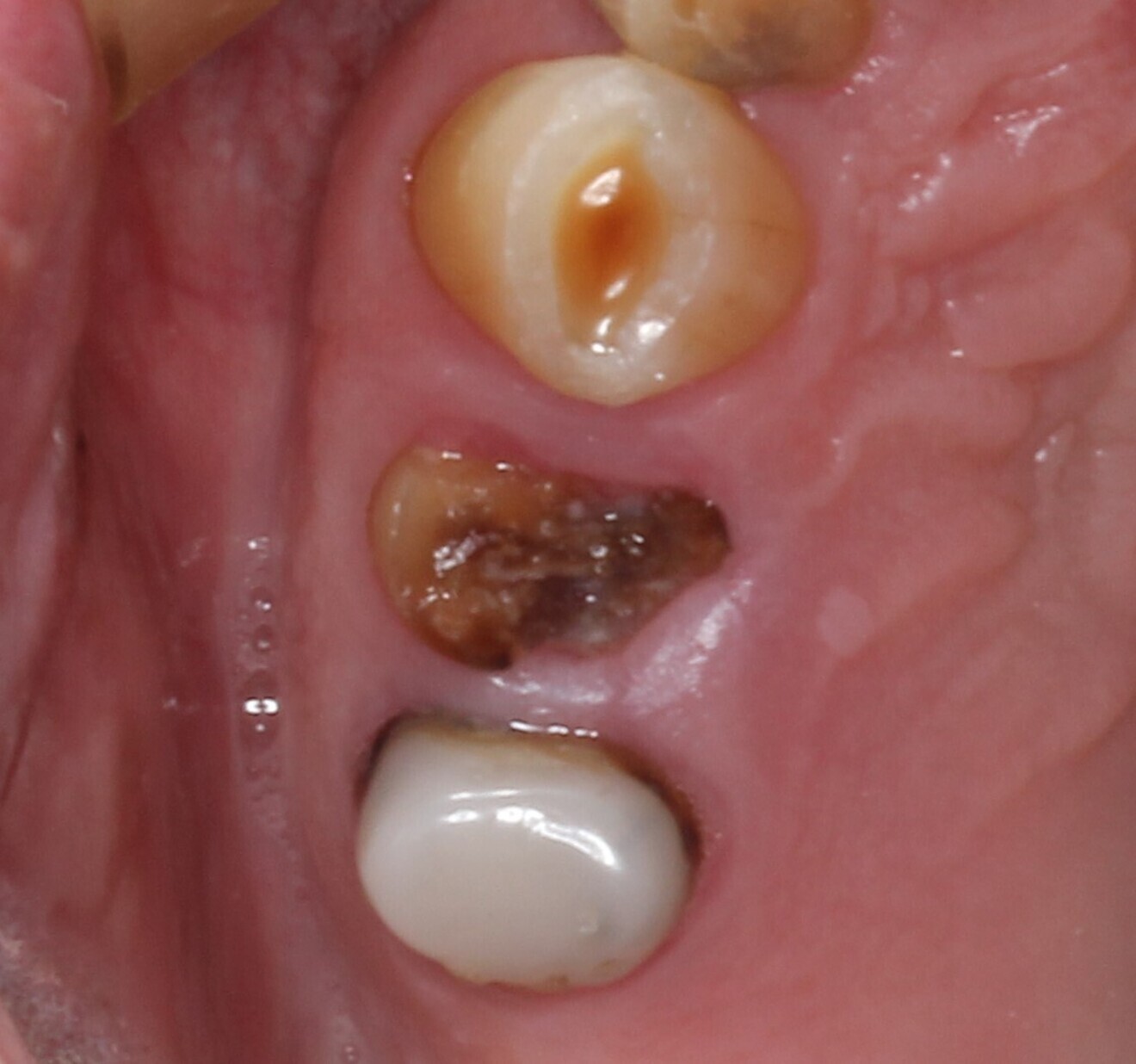 Fig. 2: Pre-op situation, showing the maxillary right first premolar with a poor restorative prognosis.