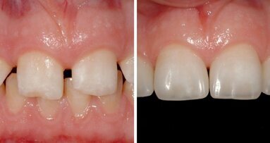 Aesthetic rehabilitation: Webinar discusses indications, limitations and clinical procedures