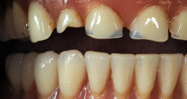 Intervención estética-funcional con barra sobre implantes en paciente con prótesis