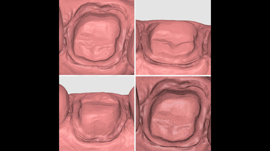 Fig. 6 - Scansione dei margini di preparazione con TRIOS 5.