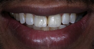 Bringing anterior direct composite restorations to life with histologic layering protocols