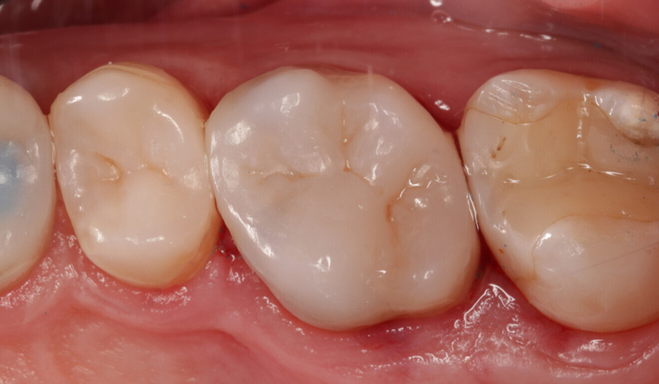 Fig. 20: Final effect after polishing with TWIST DIA for Composite. (Image: Kuraray Noritake Dental)