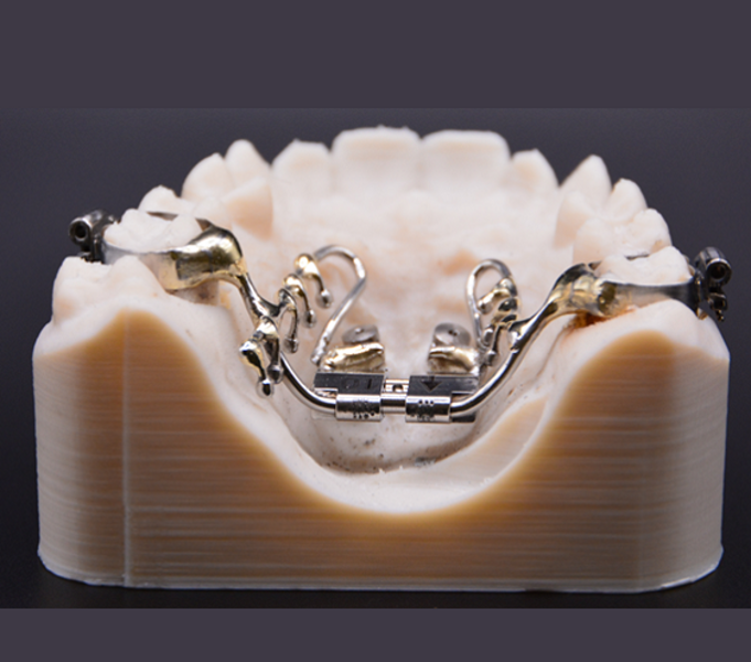 Fig. 4: Final appliance designed based on digitally or manually reconstructed implant positions. Placement occurs during a subsequent clinical visit. 
