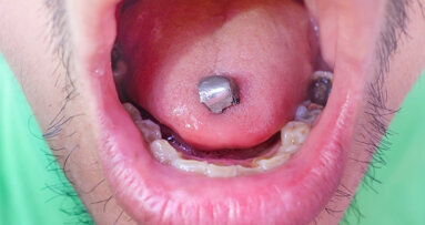 FDA changes stance on dental amalgam