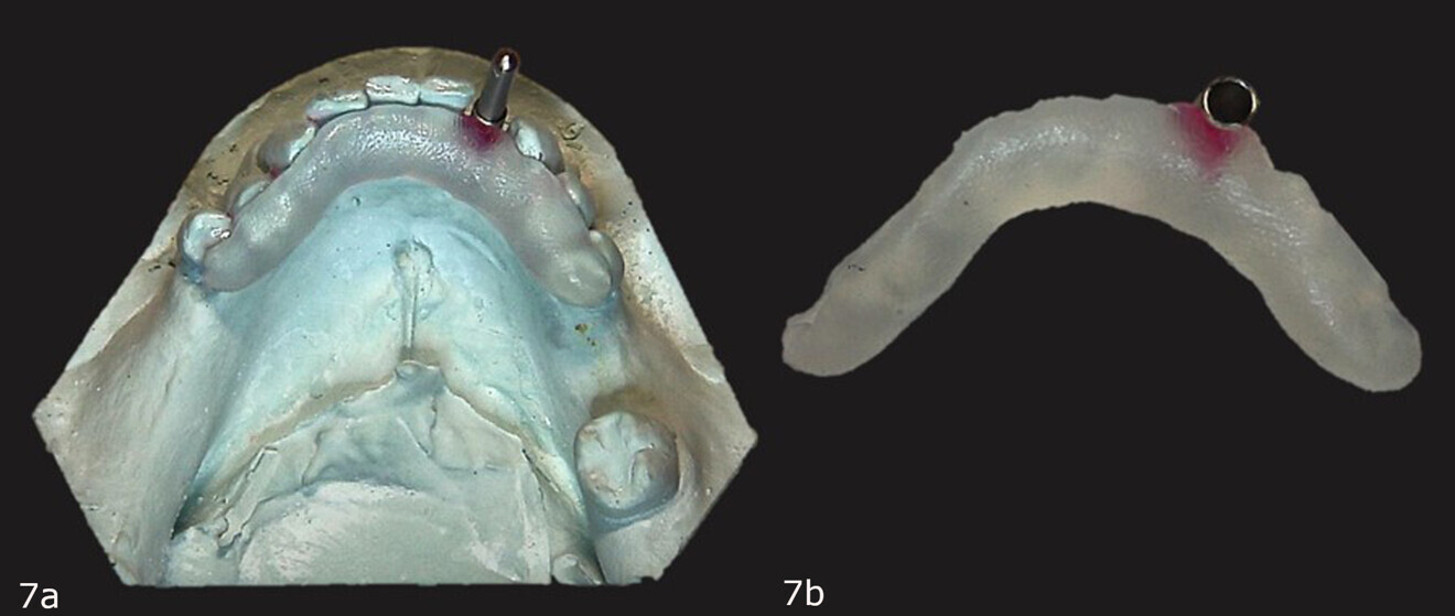 Figs. 7a & b: Resin adapted to the lingual and occlusal aspects of the teeth (a). Diagnostic guide (b).