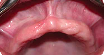 Reconstrucción ósea del máxilar atrófico