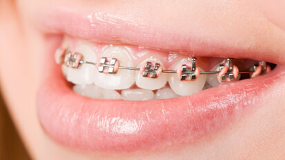 VÖK rät zu KFO-Behandlungsstart zu Beginn der Pubertät