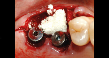 Riabilitazione implantare immediata nei settori posteriori 