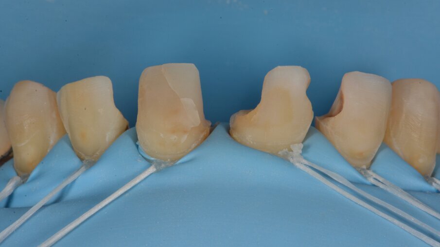 Resultaat na verwijderen van alle oude composieten en minimale buccale wegname. De vulling op tand 21 werd behouden omdat deze de week ervoor pas werd geplaatst.