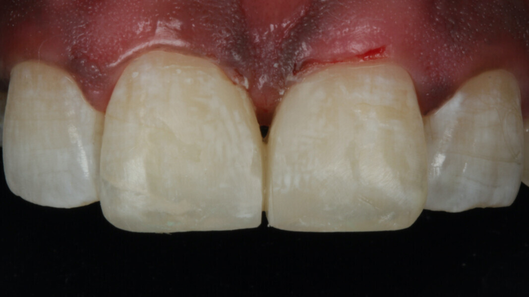 Fig 20. Gross finishing was performed before removing the rubber dam.