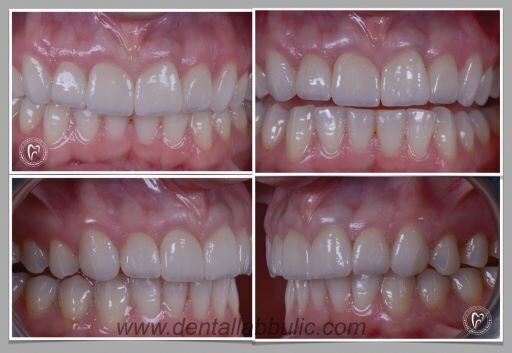 Definitivni izgled, multilayer cirkonijuma, Zubna laboratorija Bulić