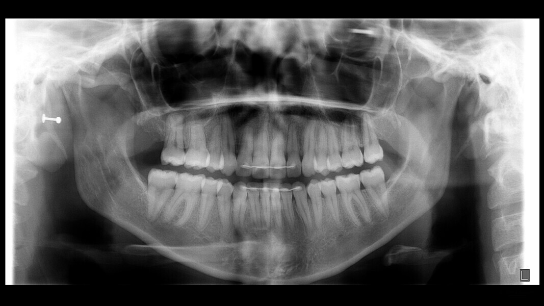Fig. 16: Final dental panoramic tomogram.
