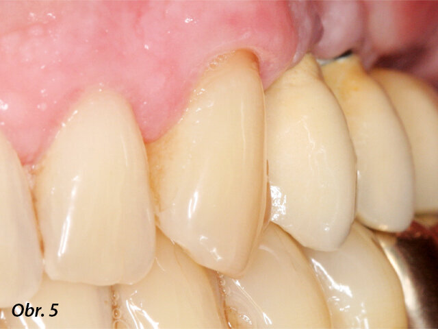 Bukální pohled na fixní částečnou náhradu.