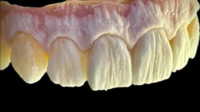 Micro-layering: A great concept for zirconia-based screw-retained implant-supported prostheses