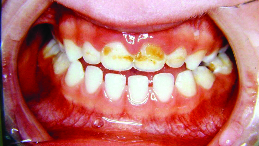Early Childhood Caries: A Continuing Epidemic Oral Health Problem in the United Arab Emirates