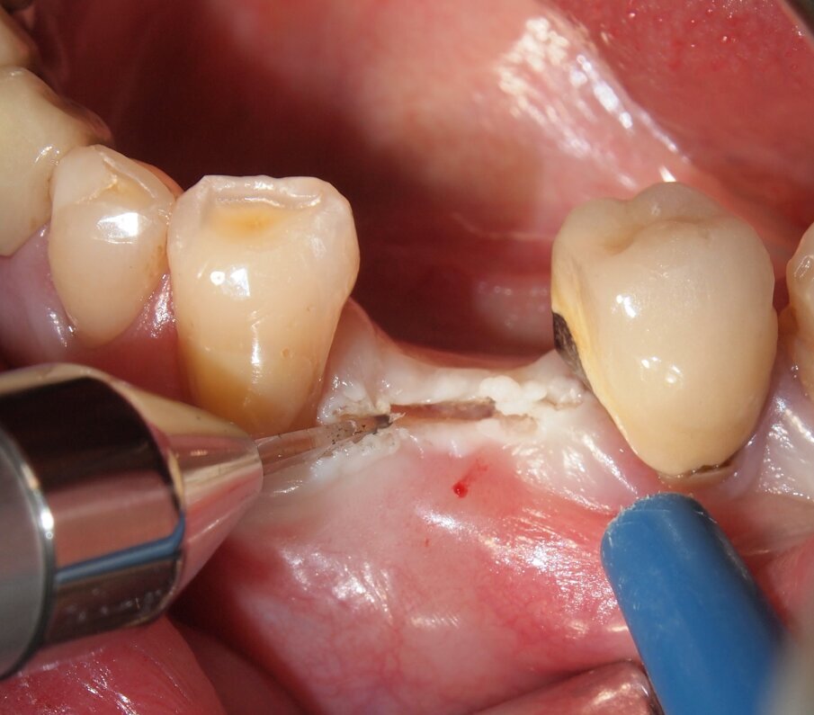 Fig. 5 - Caso clinico 1. Incisione dei tessuti molli con laser a diodi da 915 nm e inserto in zaffiro. Si apprezza macroscopicamente l’assenza di fenomeni di carbonizzazione.
