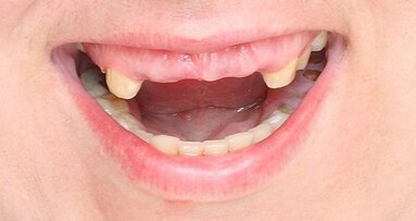 Perda de dentes pode deteriorar as funções do corpo e do cérebro