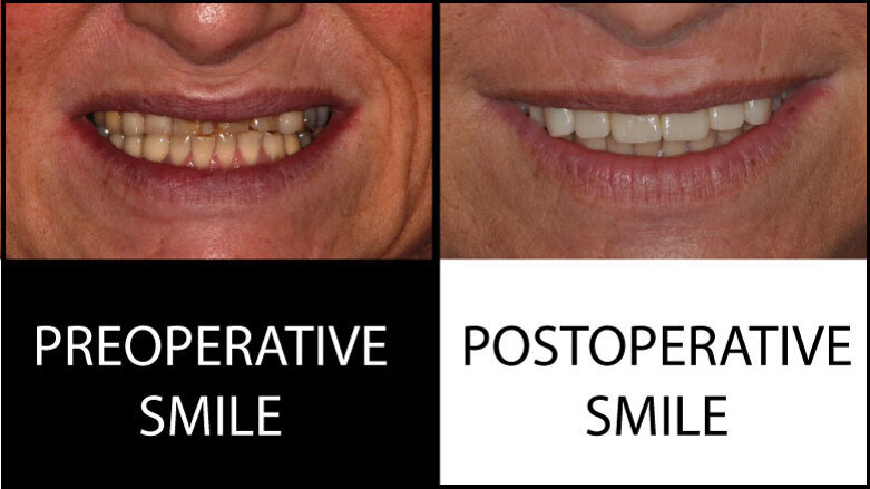 All-ceramic rehabilitation with CAD/CAM restorations made of a zirconia–reinforced lithium silicate