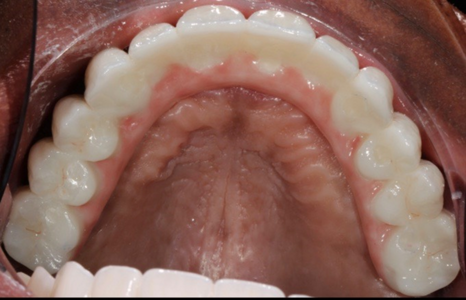 Fig. 36: Maxillary occlusal view of the completed case.