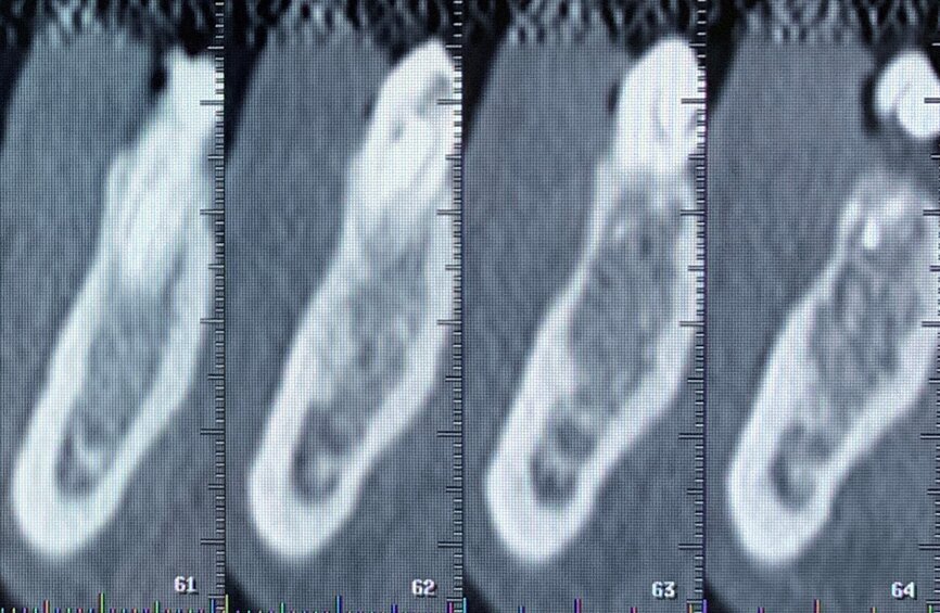 Fig. 1c: Initial situation: apical radiograph (a), intra-oral view (b) and CT scan (c).