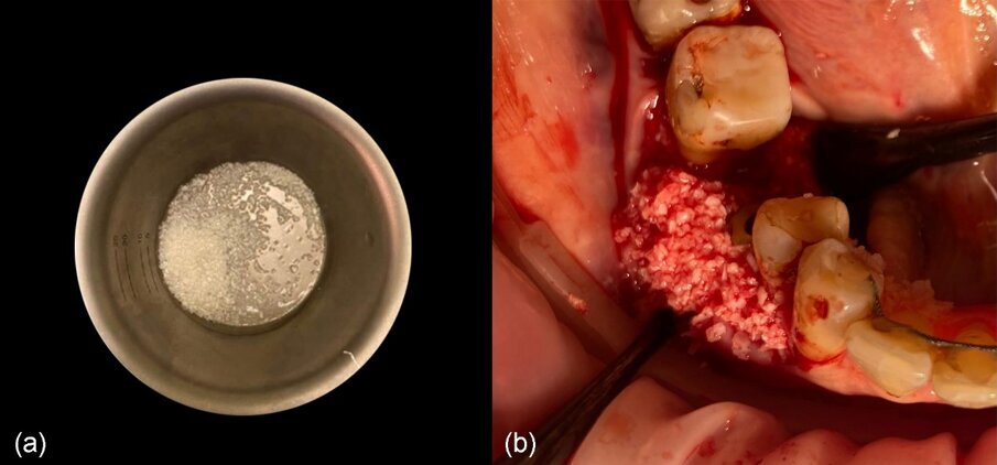 Fig. 13_a) Materiale da innesto dopo l’idratazione con soluzione salina, b) situazione clinica dopo l’innesto.