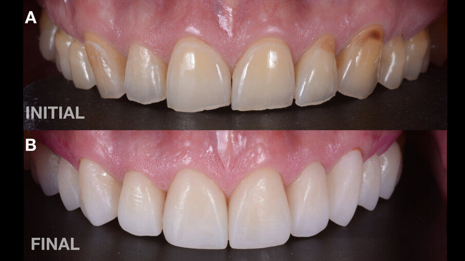 Fig. 4: Comparación entre la situación inicial y final del maxilar superior. A) Situación inicial. B) Situación final, obtenida mediante una rehabilitación completa con coronas de composite nanohíbrido fresado. 