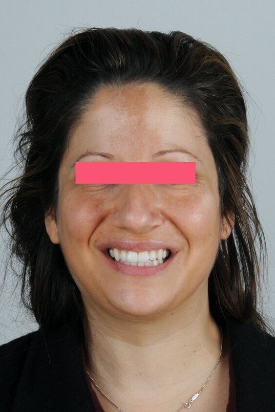 Fig. 8 - Fotografia del sorriso al termine della terapia.