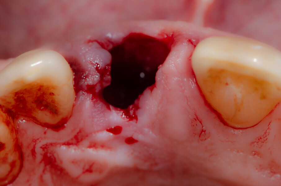 Fig. 12b: After extraction of tooth #11, occlusal view.