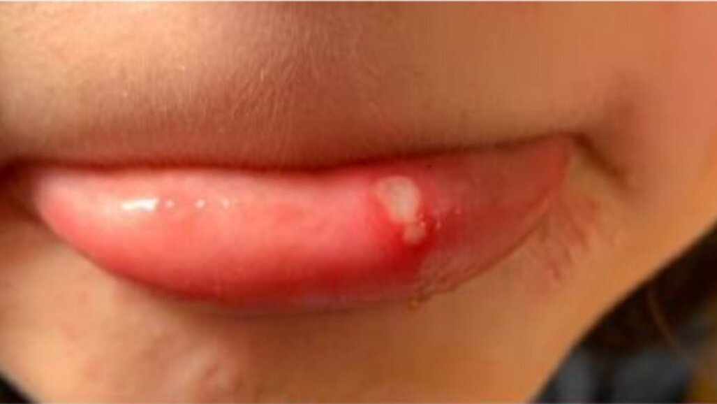 Brzo olakšanje kod afti te lezija i oštećenja usne sluznice uz Curasept Afterapid