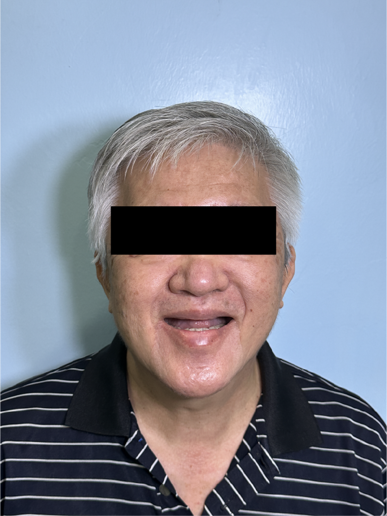 Fig. 1c: Pre-treatment open mouth view demonstrating the edentulous maxillary arch and remaining mandibular teeth.