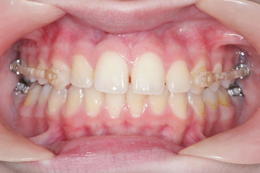 Fig. 11: Accomplishment of a Class I platform after three months of Motion. Case ready to scan and submit to Reveal.