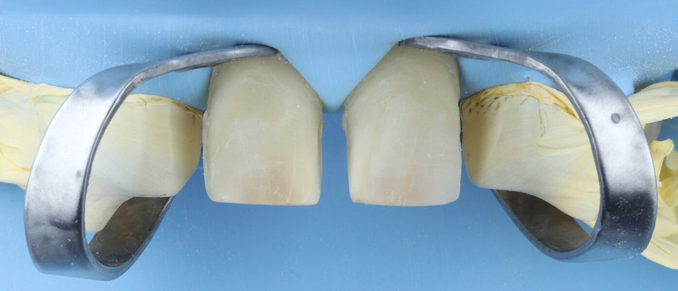 Fig. 16: Isolation of adjacent teeth with PTFE tape to facilitate excess cement removal.