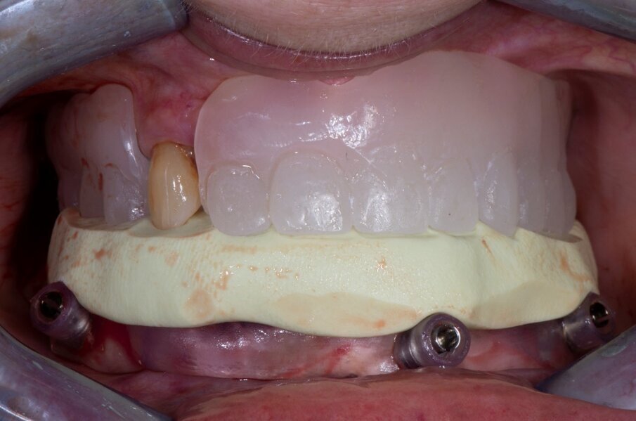 Fig. 6_Fissaggio dima chirurgica inferiore con pin di ancoraggio e superiore silicone e dima bariata.