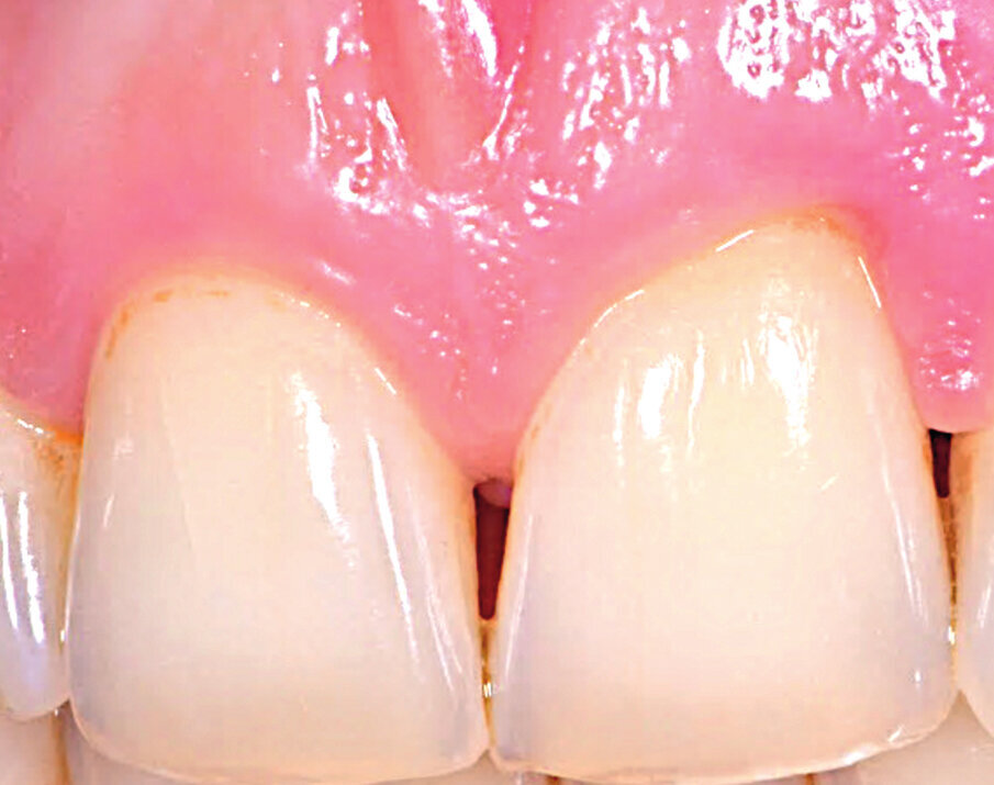 Fig. 5 - Guarigione a 2 mesi dove si nota la progressiva copertura della recessione.