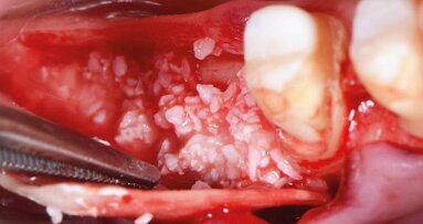 Implantologe beleuchtet knöcherne Augmentation mit GBR-Technik