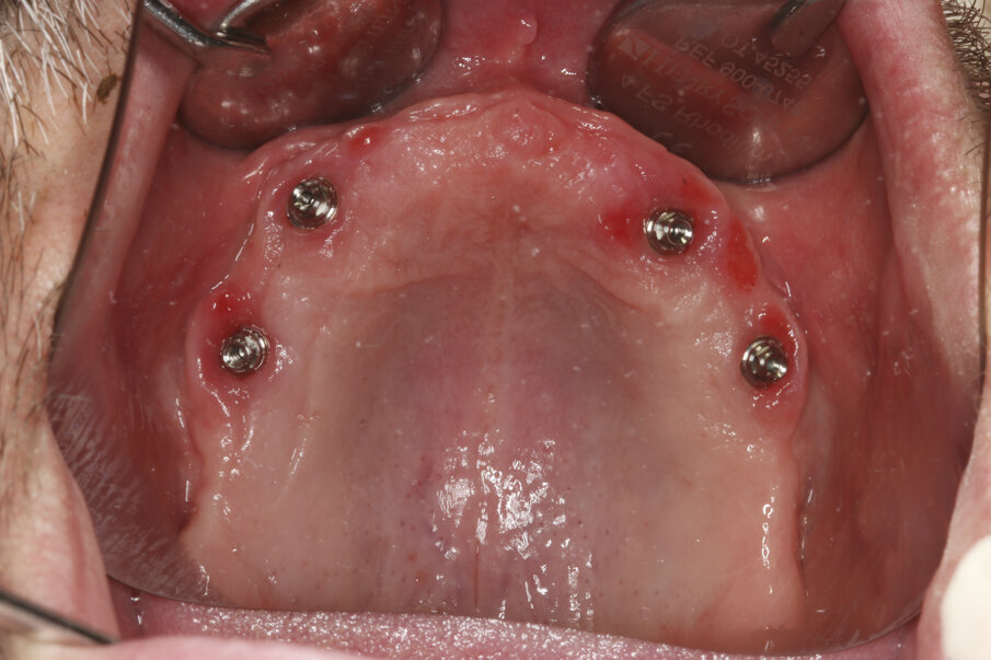 Fig. 15: Healed soft tissue eight weeks after implant placement.