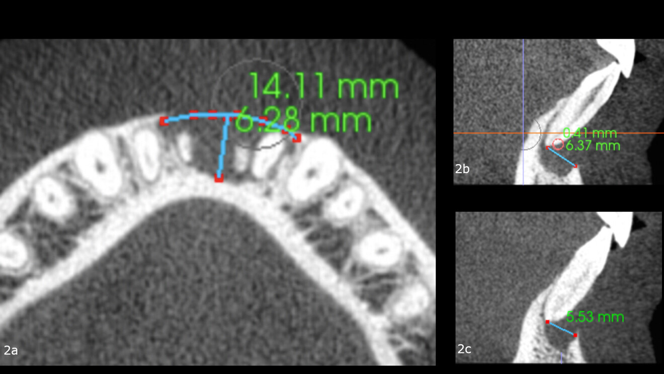 Figs. 2a–c: Horizontal view of the i-CAT scan showing a large bone defect (a). Vertical views of both central incisors showing the bone loss (b & c).