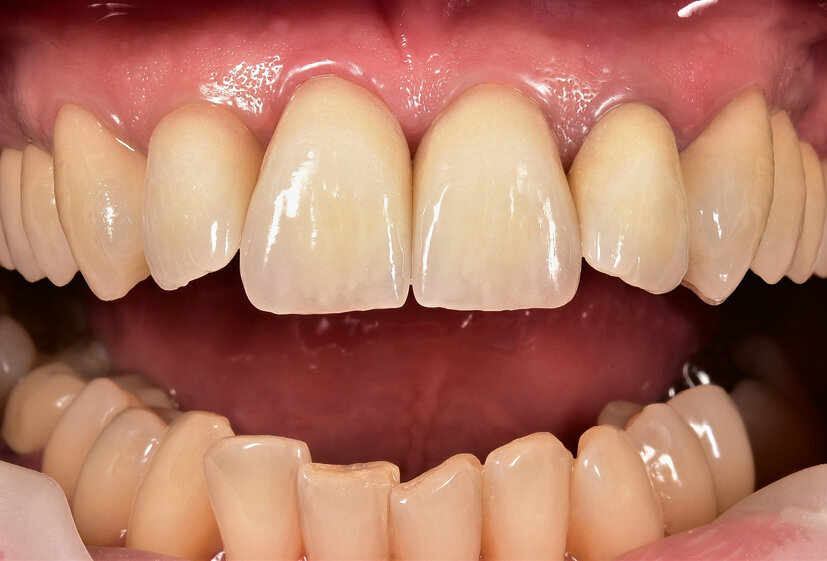 Fig. 17: The final choice fell on the IPS Style restorations: shown in the mouth
