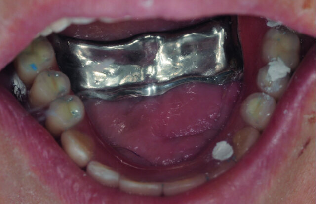 Fig. 6a : Bridge maxillaire vissé avec une entretoise palatine.