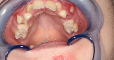 “Praatjes vullen geen gaatjes, maar voorkomen gaatjes”