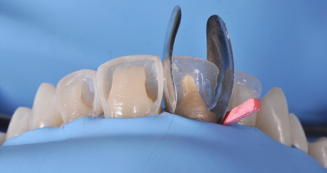 Fig. 14: Build-up of the interproximal walls with CLEARFIL MAJESTY ES-2 Premium in the shade A1D and establishing of the contact points using anatomical sectional matrices for the posterior area placed vertically.